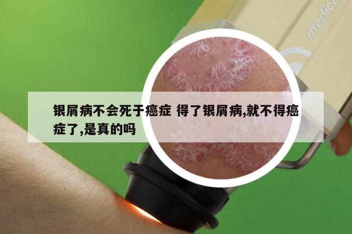 银屑病不会死于癌症 得了银屑病,就不得癌症了,是真的吗