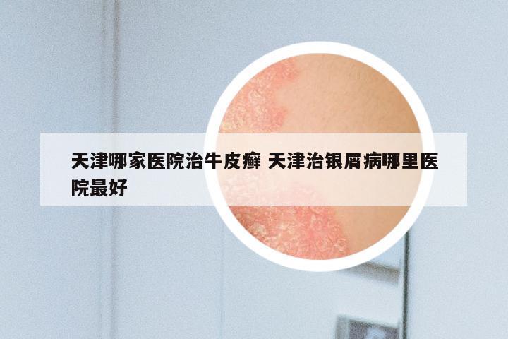 天津哪家医院治牛皮癣 天津治银屑病哪里医院最好