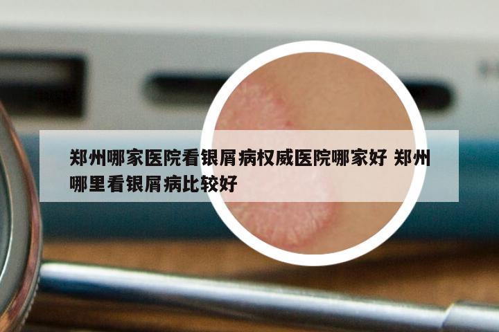 郑州哪家医院看银屑病权威医院哪家好 郑州哪里看银屑病比较好