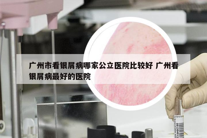 广州市看银屑病哪家公立医院比较好 广州看银屑病最好的医院