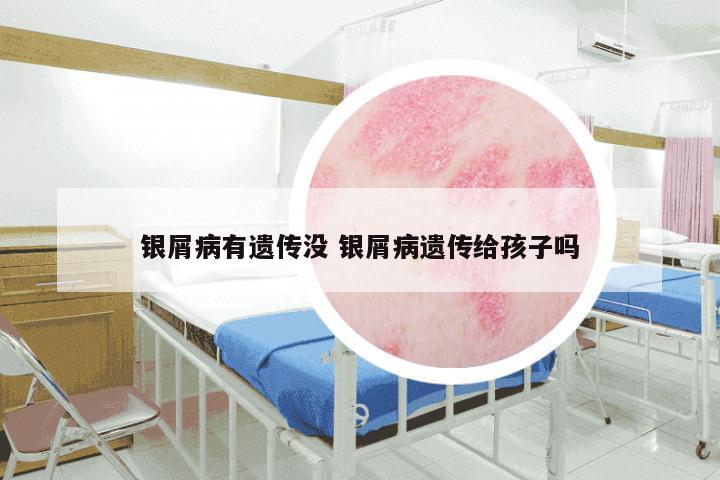 银屑病有遗传没 银屑病遗传给孩子吗