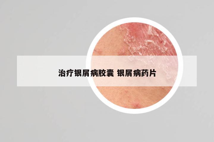 治疗银屑病胶囊 银屑病药片