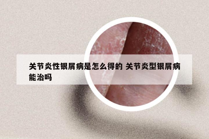 关节炎性银屑病是怎么得的 关节炎型银屑病能治吗