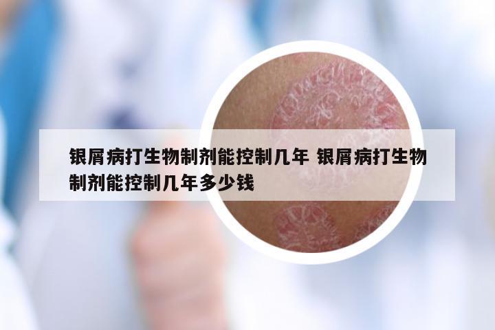 银屑病打生物制剂能控制几年 银屑病打生物制剂能控制几年多少钱