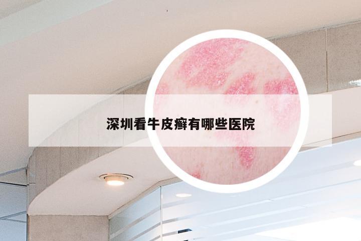深圳看牛皮癣有哪些医院