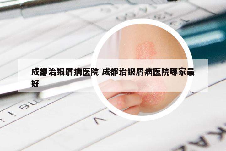 成都治银屑病医院 成都治银屑病医院哪家最好