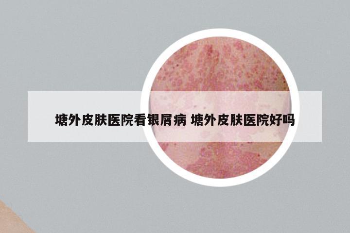 塘外皮肤医院看银屑病 塘外皮肤医院好吗