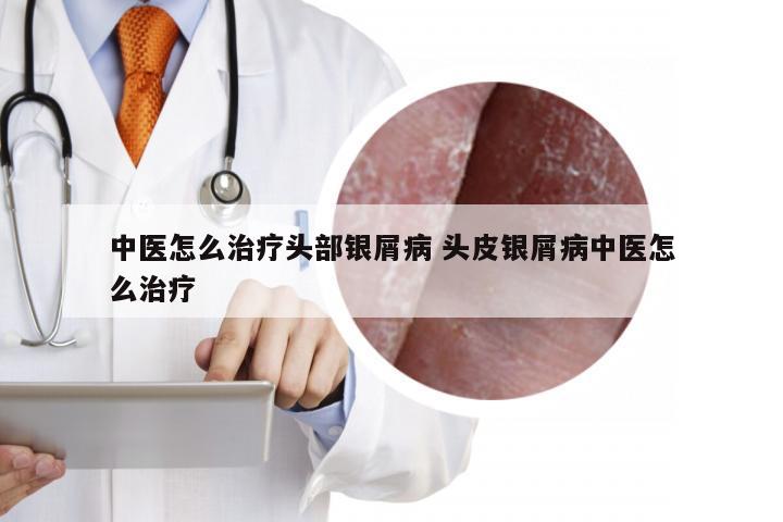 中医怎么治疗头部银屑病 头皮银屑病中医怎么治疗