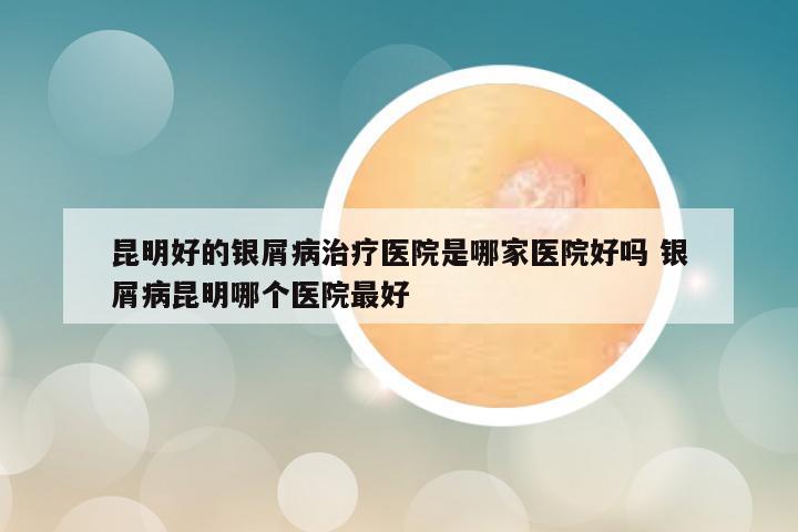 昆明好的银屑病治疗医院是哪家医院好吗 银屑病昆明哪个医院最好