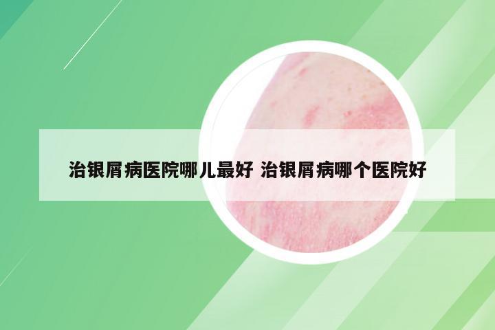 治银屑病医院哪儿最好 治银屑病哪个医院好