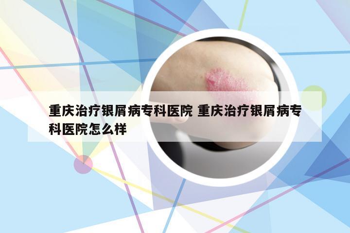 重庆治疗银屑病专科医院 重庆治疗银屑病专科医院怎么样