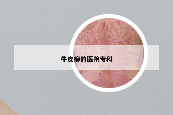 牛皮癣的医院专科