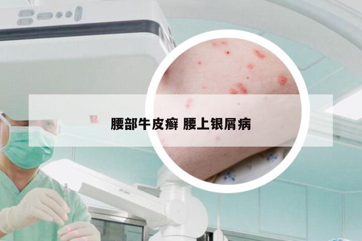 腰部牛皮癣 腰上银屑病