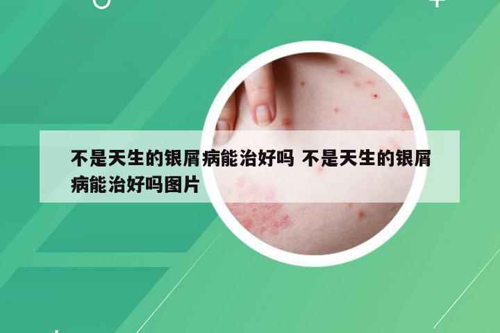 不是天生的银屑病能治好吗 不是天生的银屑病能治好吗图片