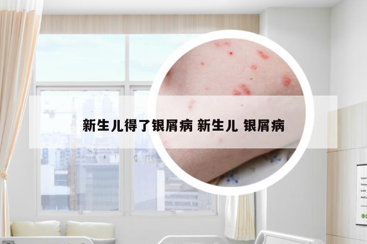新生儿得了银屑病 新生儿 银屑病