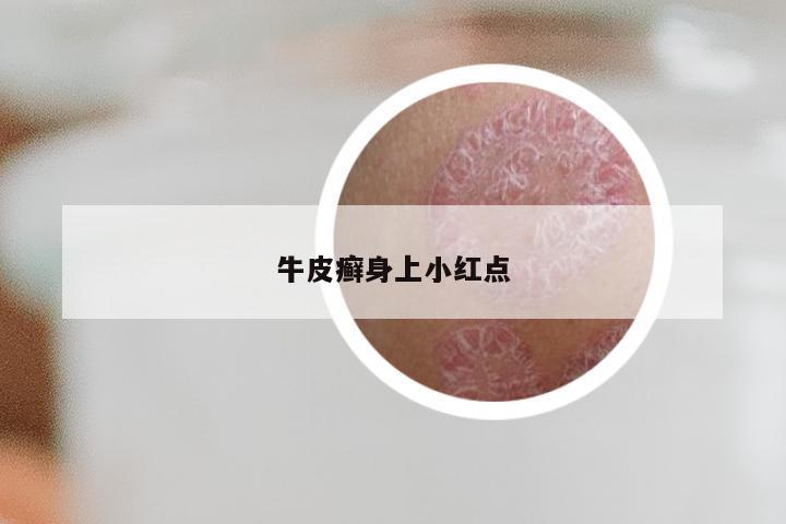牛皮癣身上小红点