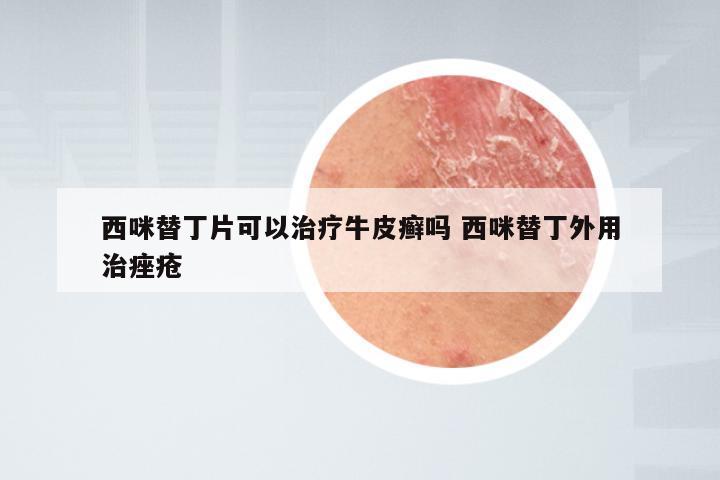 西咪替丁片可以治疗牛皮癣吗 西咪替丁外用治痤疮