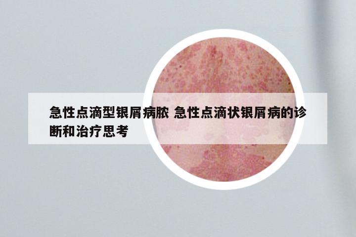 急性点滴型银屑病脓 急性点滴状银屑病的诊断和治疗思考