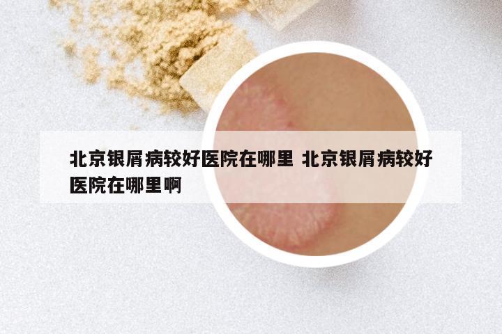 北京银屑病较好医院在哪里 北京银屑病较好医院在哪里啊