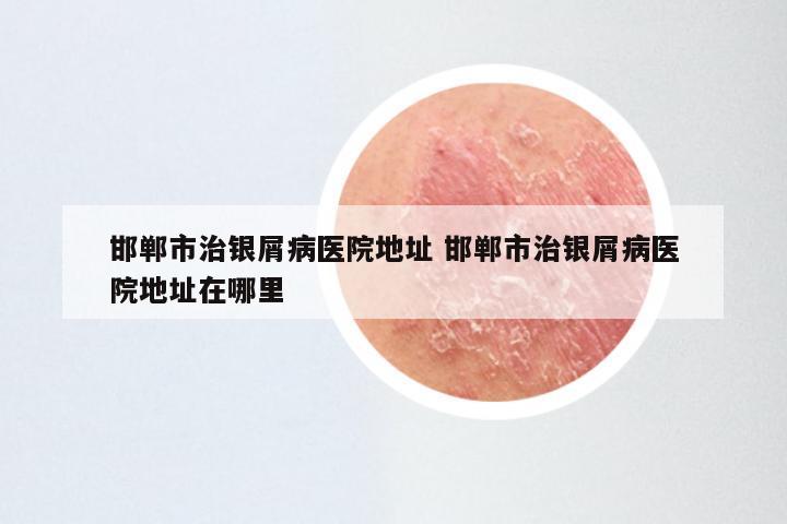 邯郸市治银屑病医院地址 邯郸市治银屑病医院地址在哪里