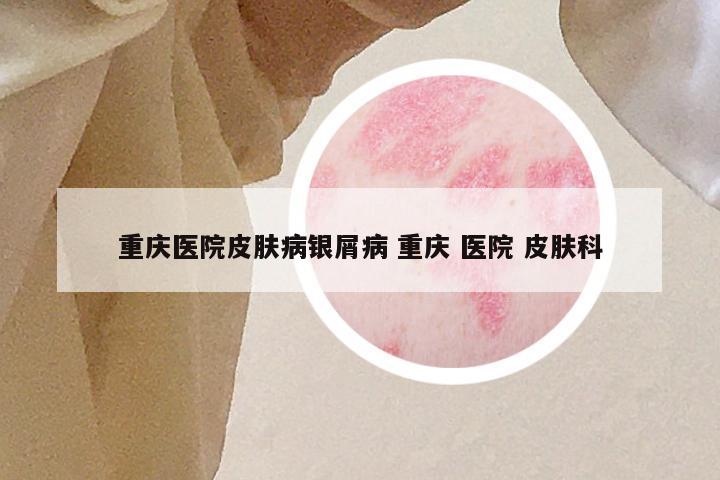 重庆医院皮肤病银屑病 重庆 医院 皮肤科