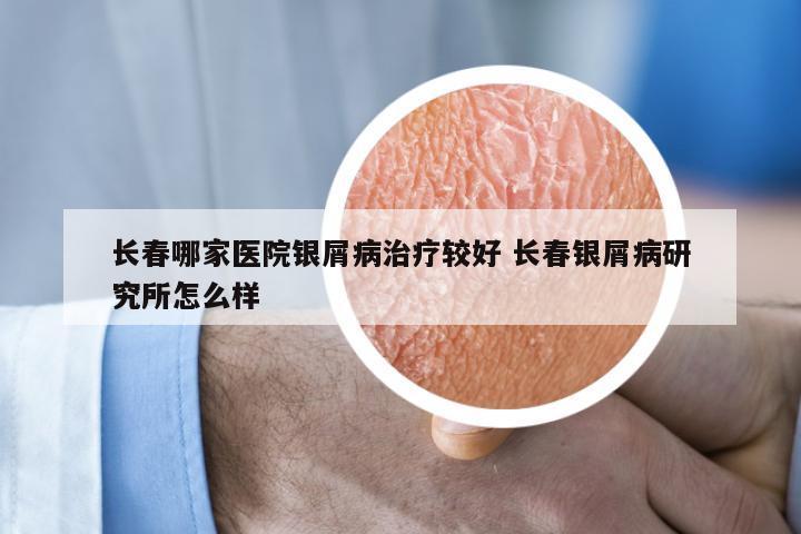 长春哪家医院银屑病治疗较好 长春银屑病研究所怎么样