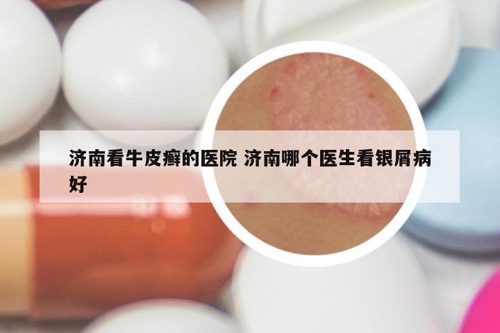 济南看牛皮癣的医院 济南哪个医生看银屑病好