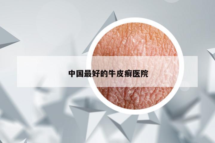 中国最好的牛皮癣医院