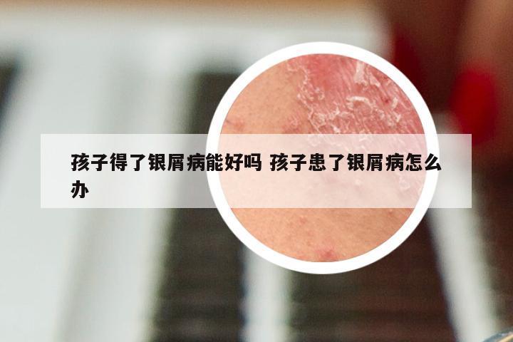 孩子得了银屑病能好吗 孩子患了银屑病怎么办