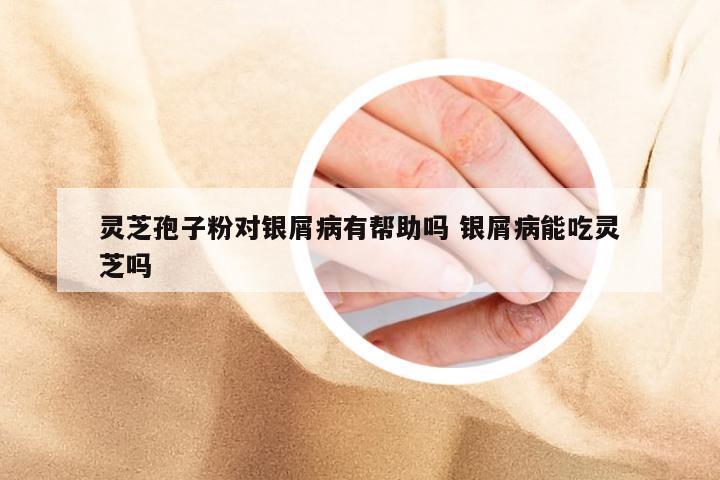 灵芝孢子粉对银屑病有帮助吗 银屑病能吃灵芝吗