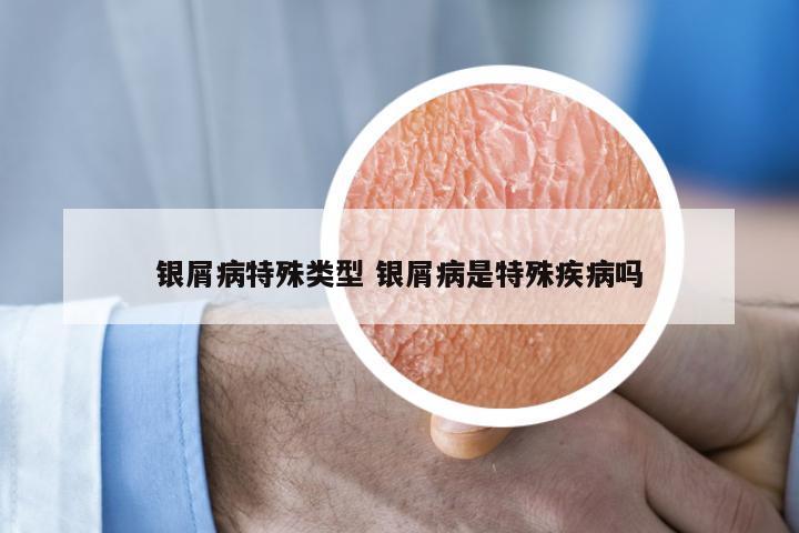 银屑病特殊类型 银屑病是特殊疾病吗