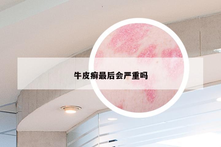 牛皮癣最后会严重吗