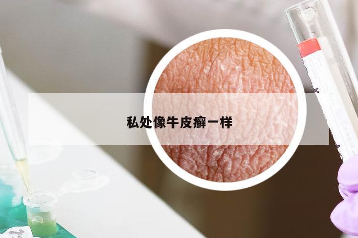 私处像牛皮癣一样