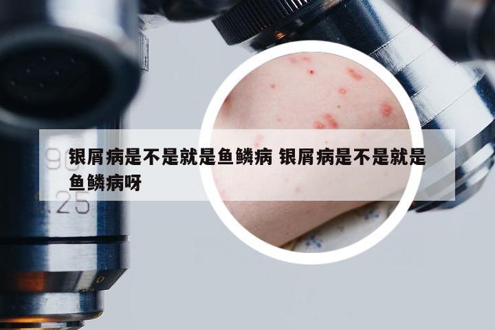 银屑病是不是就是鱼鳞病 银屑病是不是就是鱼鳞病呀