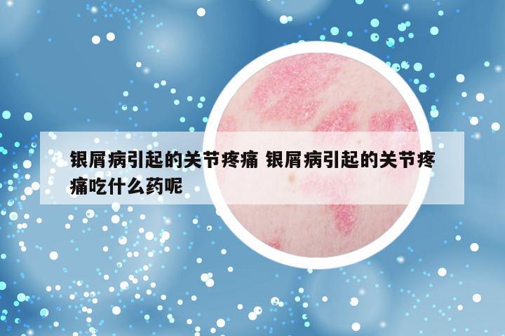 银屑病引起的关节疼痛 银屑病引起的关节疼痛吃什么药呢