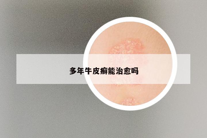 多年牛皮癣能治愈吗