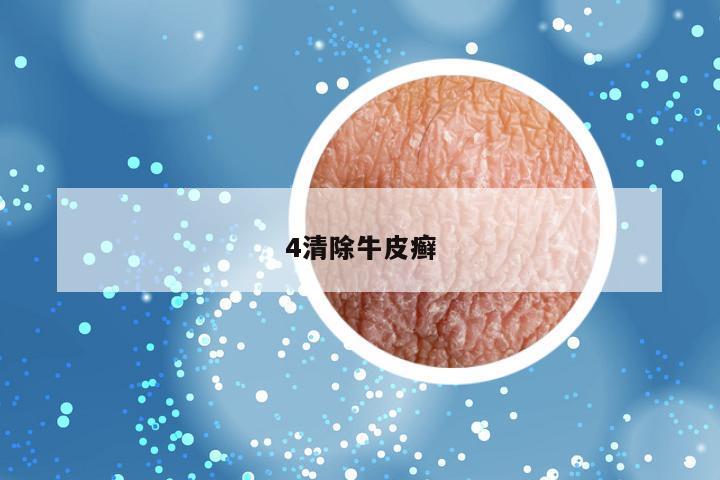 4清除牛皮癣