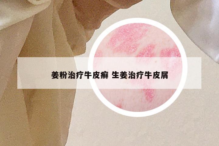 姜粉治疗牛皮癣 生姜治疗牛皮屑