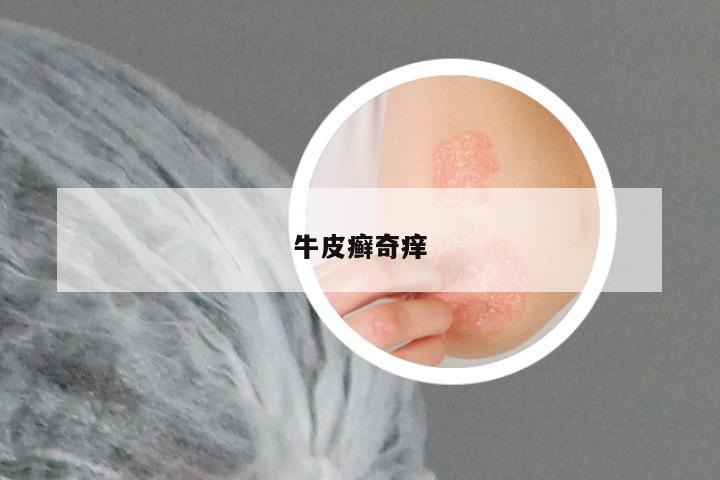 牛皮癣奇痒