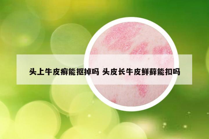 头上牛皮癣能抠掉吗 头皮长牛皮鲜藓能扣吗