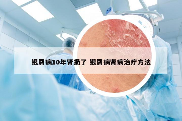 银屑病10年肾损了 银屑病肾病治疗方法