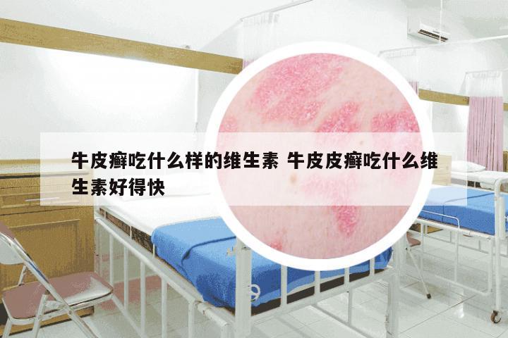 牛皮癣吃什么样的维生素 牛皮皮癣吃什么维生素好得快