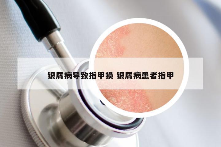 银屑病导致指甲损 银屑病患者指甲