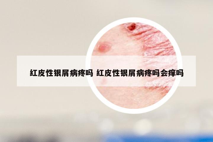 红皮性银屑病疼吗 红皮性银屑病疼吗会痒吗