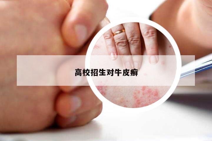 高校招生对牛皮癣