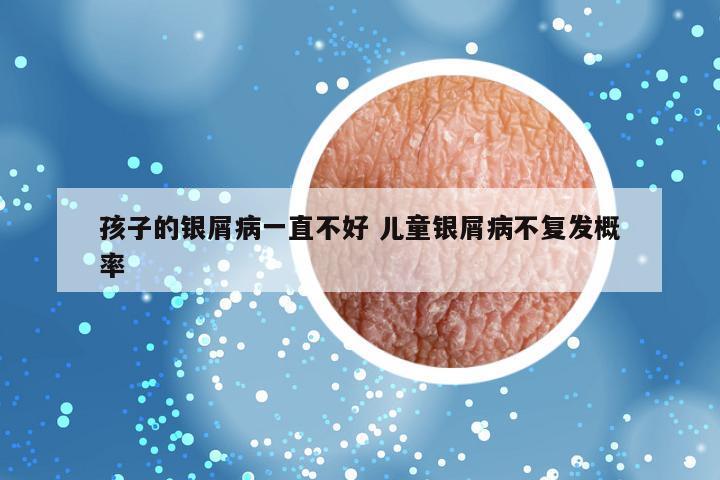 孩子的银屑病一直不好 儿童银屑病不复发概率