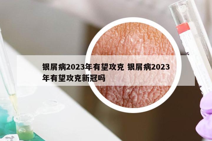 银屑病2023年有望攻克 银屑病2023年有望攻克新冠吗