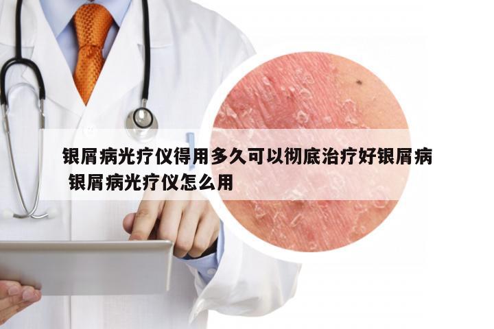 银屑病光疗仪得用多久可以彻底治疗好银屑病 银屑病光疗仪怎么用