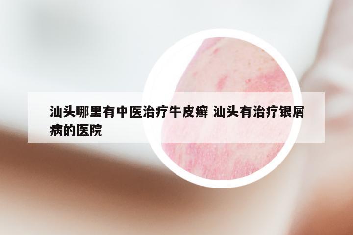 汕头哪里有中医治疗牛皮癣 汕头有治疗银屑病的医院