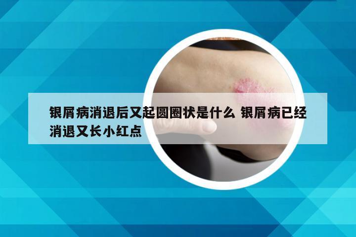 银屑病消退后又起圆圈状是什么 银屑病已经消退又长小红点